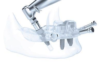 cirugia-dental-guiada-zaragoza