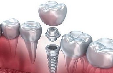 implantes-de-carga-inmediata-en-zaragoza