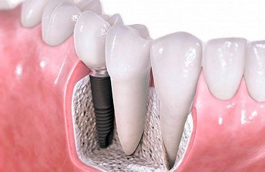regeneracion-osea-dental