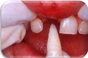 Traumatismo dental en niños