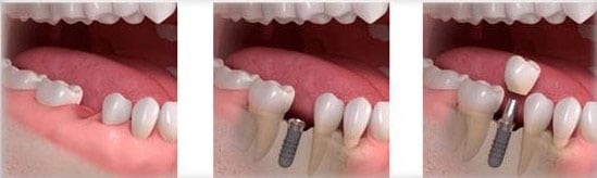 Pasos de un Implante Dental