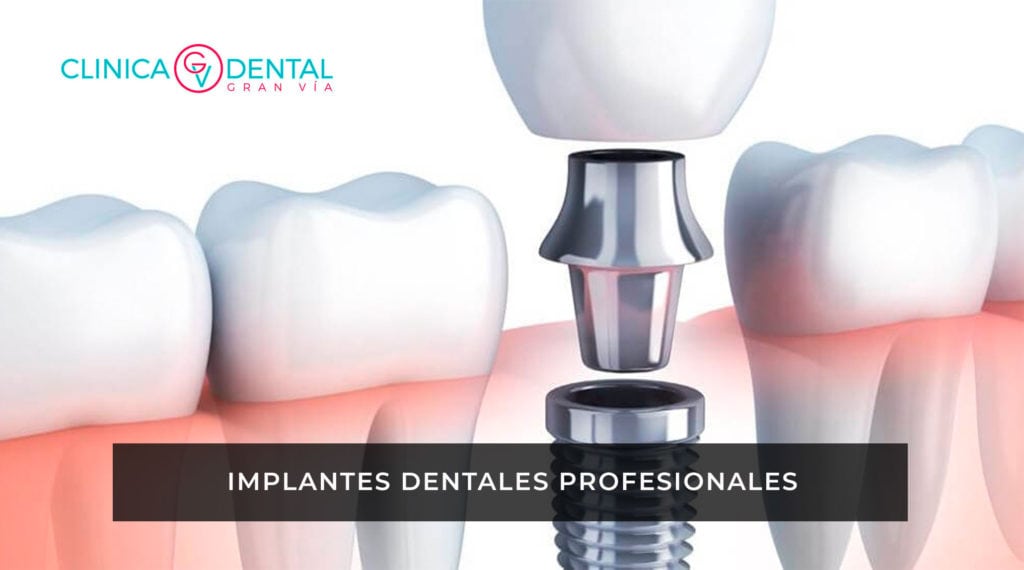 Implante Dental