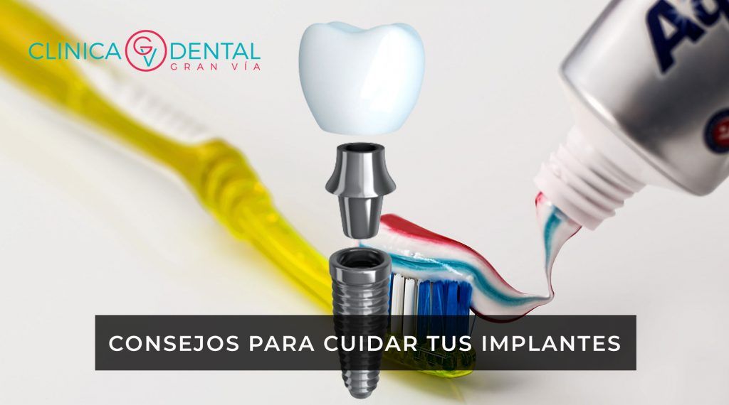 Consejos para cuidar los Implantes Dentales
