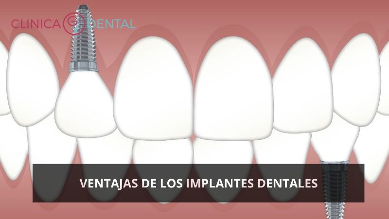 Ventajas de los Implantes Dentales