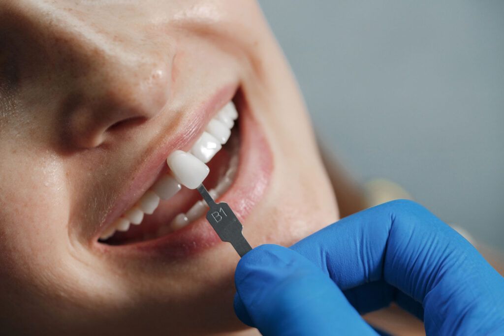 Carillas dentales: mitos y verdades
